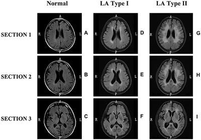 DNA Methylation Profiling Reveals the Change of Inflammation-Associated ZC3H12D in Leukoaraiosis